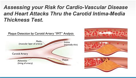 intimal thickening of carotid artery